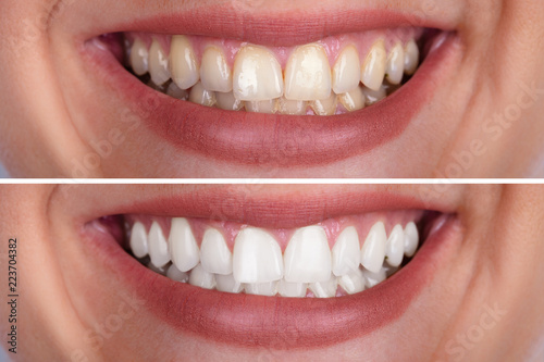Cuadros en Lienzo Woman's Teeth Before And After Whitening