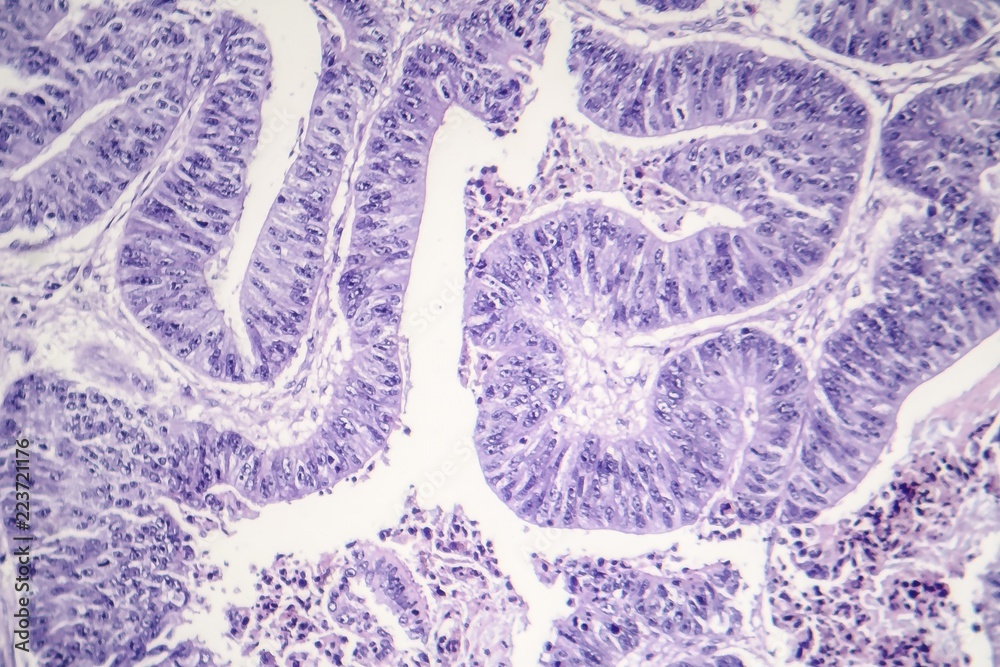 Squamous Cell Microscope Esophageal squamous cell carcinoma, light micrograph, photo under ...