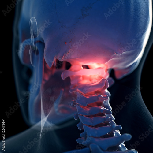 Cuadros en Lienzo 3d rendered medically accurate illustration of a painful atlas bone