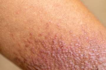 A physical of Atopic dermatitis (AD), also known as atopic eczema, is a type of inflammation of the skin (dermatitis).