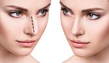 Female Face Before And After Cosmetic Nose Surgery.