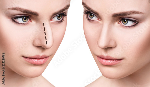 Fotografia  Female face before and after cosmetic nose surgery.