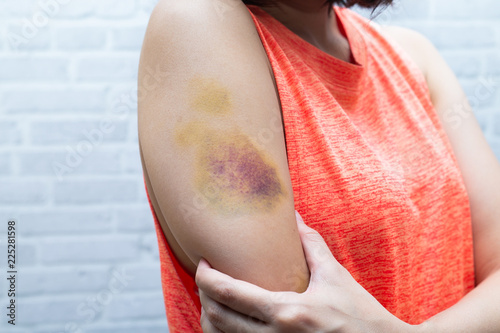 Fotografie, Obraz Bruise on woman arm. Injection bruises. Doctor and patient.