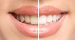 © New Africa - Smiling woman before and after teeth whitening procedure, closeup