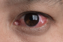 Human's Red Eye Conjunctivitis