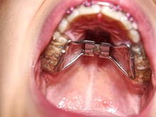 Kid Wearing Orthodontic Palatal Expanding Trainer.  Birth Dental Deffect