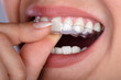 © Andrey Popov - Woman Putting Transparent Aligner In Teeth