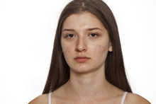 Teenage Girl With Problematic Skin On White Background