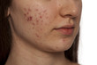 closeup of teenage girl with problematic skin on white background