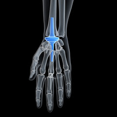 3d rendered medically accurate illustration of a wrist replacement