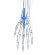 3d rendered medically accurate illustration of a wrist replacement