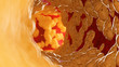 © Sebastian Kaulitzki - 3d rendered medically accurate illustration of fat inside of an artery