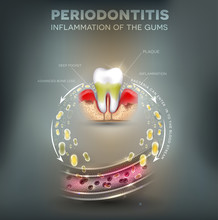 Periodontitis, inflammation of the gums bacteria can enter in to the blood stream and initiate complications in other parts of body, such as stroke, diabetes and heart disease