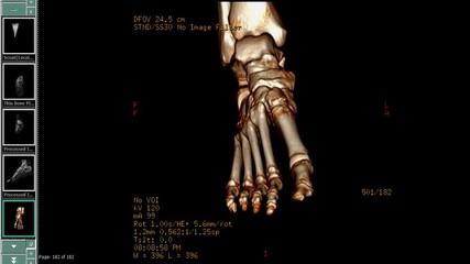 Poster - CT Scan of Right Foot 3D rendering image rotating on the monitor . medical technology concept.