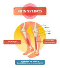 Shin Splints Vector Illustration. Leg Muscle Sport Trauma And Bone Pain.