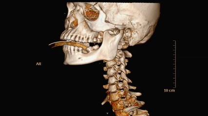 Poster - CT SCAN of Cervical Spine ( C-spine ) patient trauma case  with endotracheal tube Rotating on the monitor . Medical technology concept.