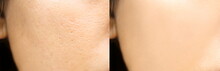 Compare Before And After (retouch Photo) Of Close Up Wide Pores Skin On Oily Face Have Pimple Of Asia Woman