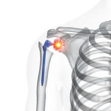 3d Rendered Medically Accurate Illustration Of A Shoulder Replacement