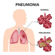 Pneumonia concept background. Realistic illustration of pneumonia vector concept background for web design