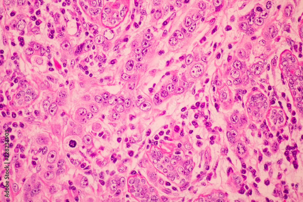 View in microscopic of pathology cross section tissue ductal cell carcinoma or adenocarcinoma diagnosis by pathologist in laboratory.H and E stain.Criteria of breast cancer.Medical concept. - obrazy, fototapety, plakaty 