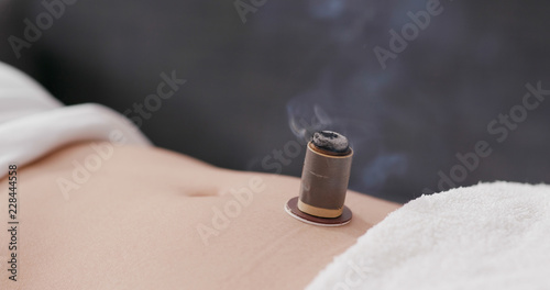 Fotografía Traditional chinese medicine moxibustion therapy
