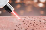 Fototapeta Sypialnia - cosmetology procedure laser freckle skin removal on body parts. close up