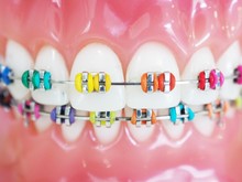 Close Up Orthodontic Model And Dentist Tool - Demonstration Teeth Model Of Multi Color Of Orthodontic Bracket Or Brace