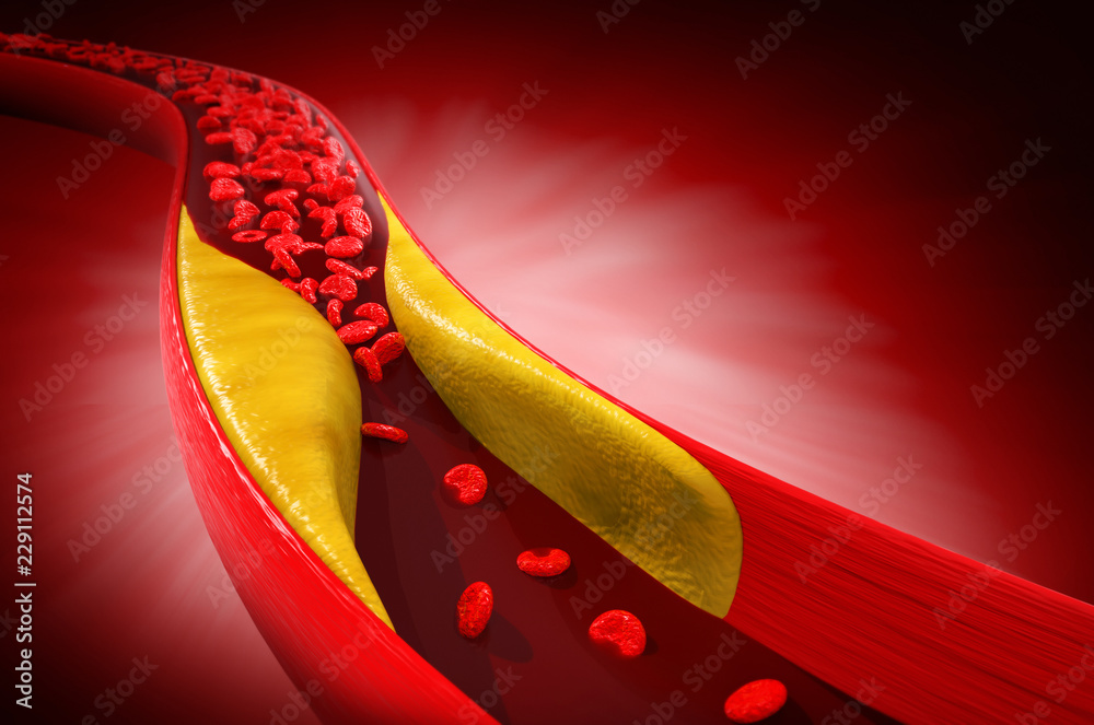 blood cells with plaque buildup of cholesterol 3d Illustration. Stock ...