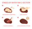 Stages of baby birth via cesarean section
