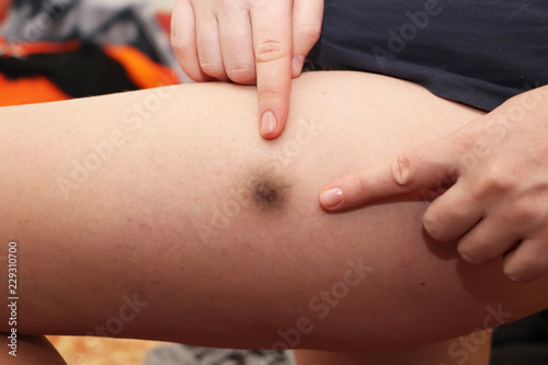 Fotografie, Obraz A bright injury injures the thigh of a young woman