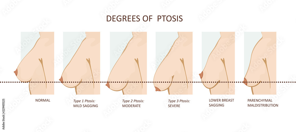 Degrees of breast ptosis - obrazy, fototapety, plakaty 