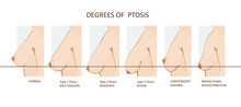 Degrees Of Breast Ptosis