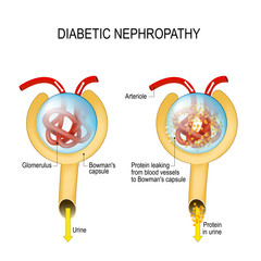 Diabetic nephropathy. diabetic kidney disease