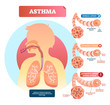 Asthma vector illustration. Disease with breathing problems diagram..