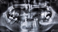 Dental X-ray With Bad Teeth
