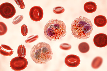 Canvas Print - Eosinophilia, blood smear showing multiple eosinophils surround by red blood cells, 3D illustration. Eosinophilia occurs in parasitic and fungal infections, allergies, autoimmune disorders, tumors