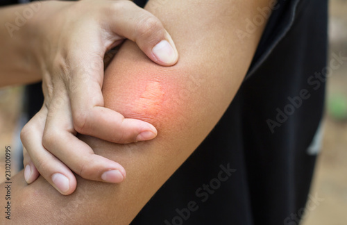 Fotografía Close-up of bee sting stuck in human skin.