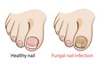 © p6m5 - Nail fungal infection