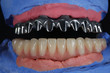 Titanium beam upper jaw with the lower ceramic prosthesis