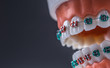 Close-up of a orthodontic model jaws and teeth with braces