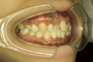 malocclusion teeth from side view