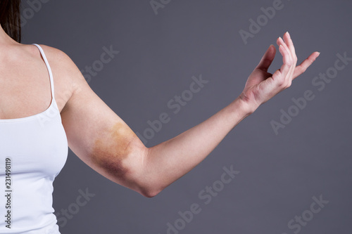 Fotografie, Obraz Bruises on the woman's hands, arms with extensive hematoma