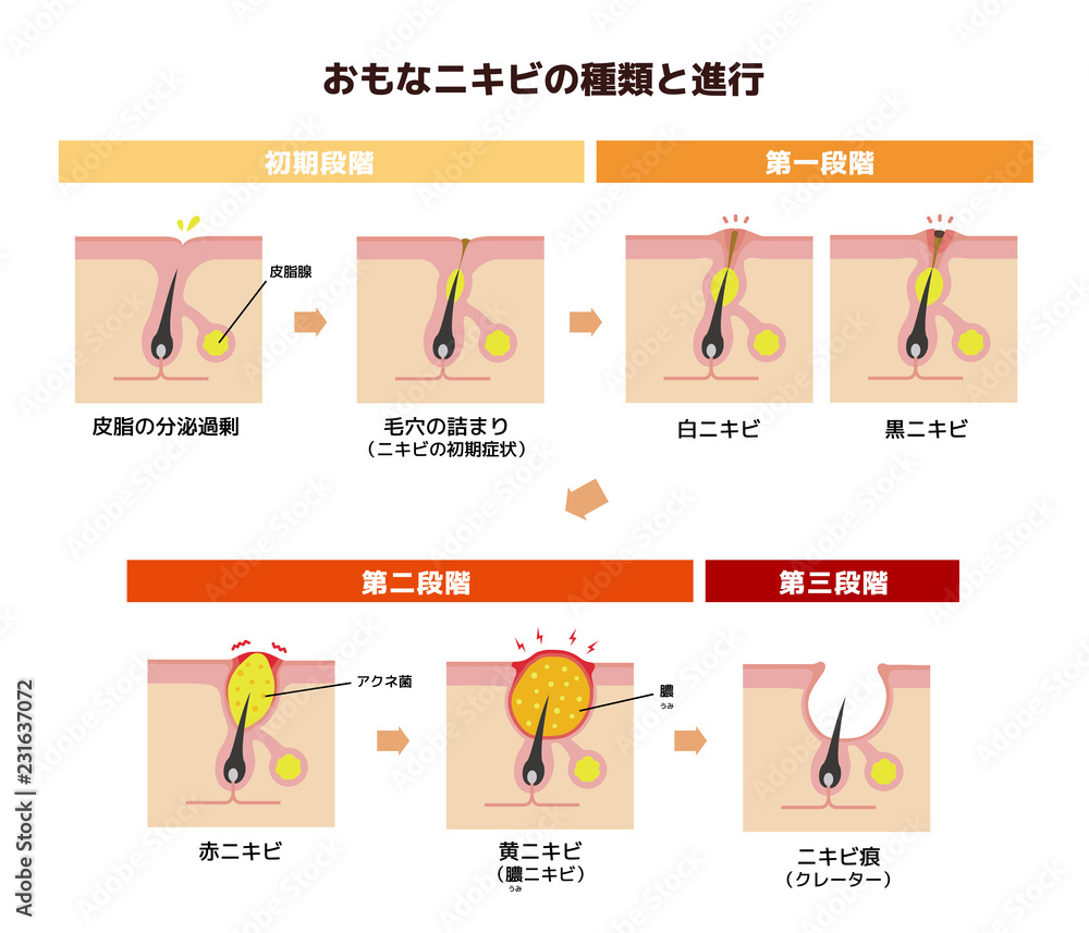 おもなニキビの種類と症状の進行 イラスト 日本語 Wall Mural Barks