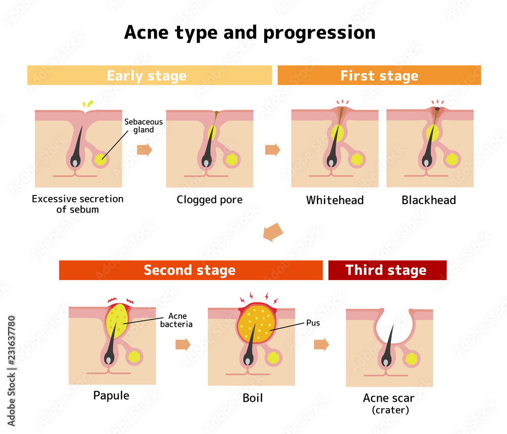 Acne types and progression illustration Stock Vector | Adobe Stock