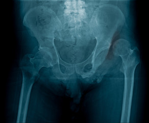 Poster - dislocation of left hip joint