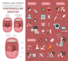 Tonsils And Throat Diseases. Peritonsillar Abscess Symptoms, Treatment Icon Set. Medical Infographic Design