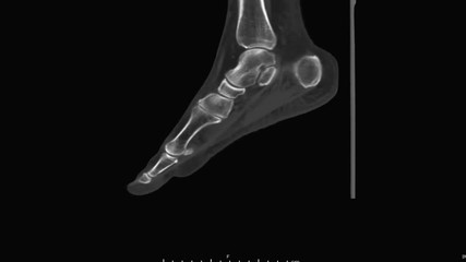 Poster - ct scan of left foot 3d rendering image rotating on the monitor . medical technology concept.