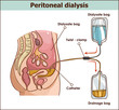 peritoneal dialysis are both used to treat kidney - vector illustration