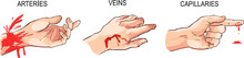 Vector Illustration Of A  Arterial And Venous Bleeding