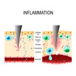 Inflammation. Immune system